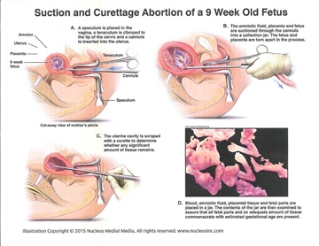 Picture of Suction and Curettage Abortion Diagram