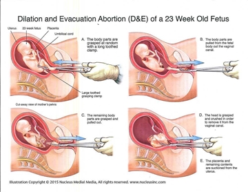 Picture of Dilation and Evacuation Abortion Diagram