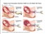 Picture of Dilation and Evacuation Abortion Diagram